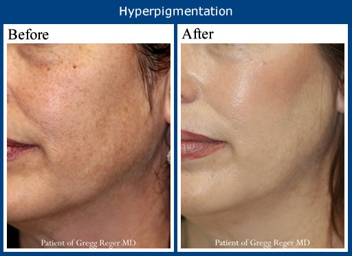 microdermabrasion before and after mode