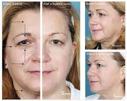 Does Your Face Need A Lift But You Don't Want Fillers?