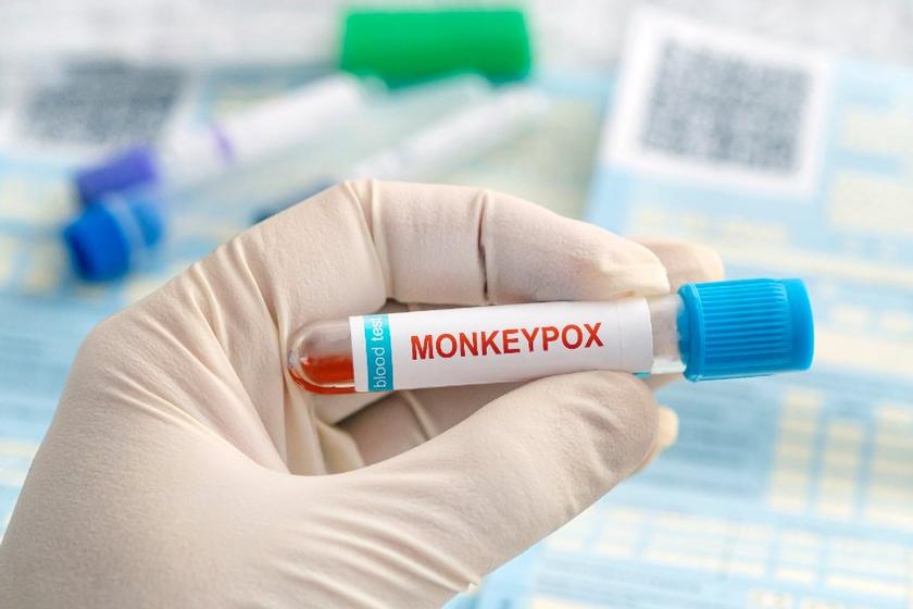 Montgomery County Confirms 2nd Probable Case Of Monkeypox