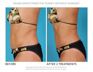 Woodlands Wellness and Cosmetic Center offers Vaser Shape