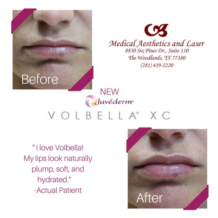 Medical Aesthetics and Laser in The Woodlands offering the latest in lip augmentation