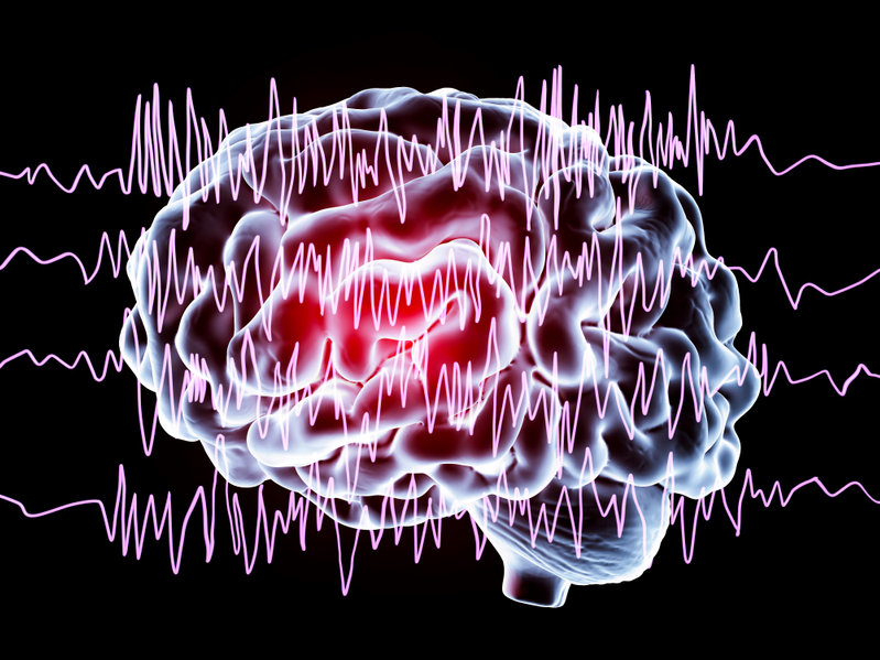 Epilepsy: What You Need to Know