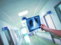 Exposing lung cancer's silent threat: 4 things to know