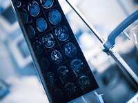 Neuromodulation: Brain surgery for common conditions