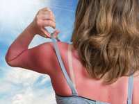 Is It Simple Sunburn - Or Do I Need A Doctor?