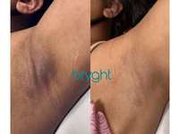 Body Bleaching Now Offered