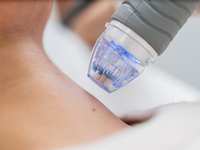 RF Microneedling: The All-Natural Treatment for a More Youthful Complexion