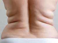 How CoolSculpting Can Help You Say Goodbye to Stubborn Fat