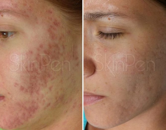 Microneedling For Acne Scars