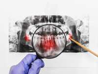 How Do I Prevent Cavities?