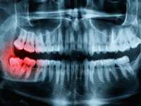 How Do I Prevent Cavities?