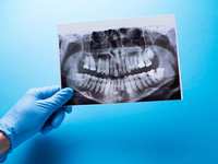 Are Dental X-Rays Necessary? 8 Reasons Why They're Important