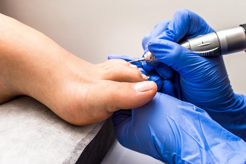 How Laser Treatment Works to Kill Toenail Fungus