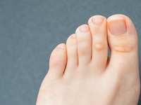 Corns Can Be In Two Places on the Foot
