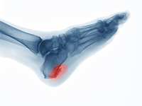 Heel Spurs: The Body’s Response to Stress on Ligaments and Tendons