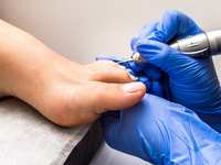 How Laser Treatment Works to Kill Toenail Fungus