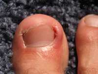 Everything You Wanted to Know About Ingrown Toenails