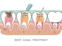 Everything You Need to Know About Root Canals in Woodlands, TX