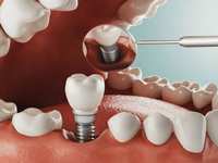 Dental Implant Recovery Timeline: What The Woodlands Patients Should Expect