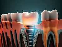 Understanding Dental Implant Costs in The Woodlands: Complete Guide