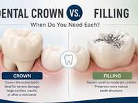 Saving Your Tooth: Crown or Filling?
