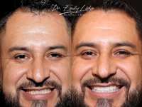 The Biggest Myth About Veneers