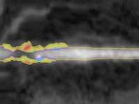 Heart Attack Prevention: State of the Art Cleerly Coronary Analysis To Detect Artery Plaque