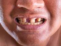 Replacing Missing Teeth: How Urgent is it to Seek Help?