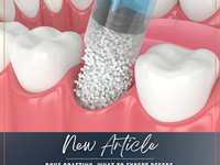 Bone Grafting: What to Expect Before, During, and After the Procedure