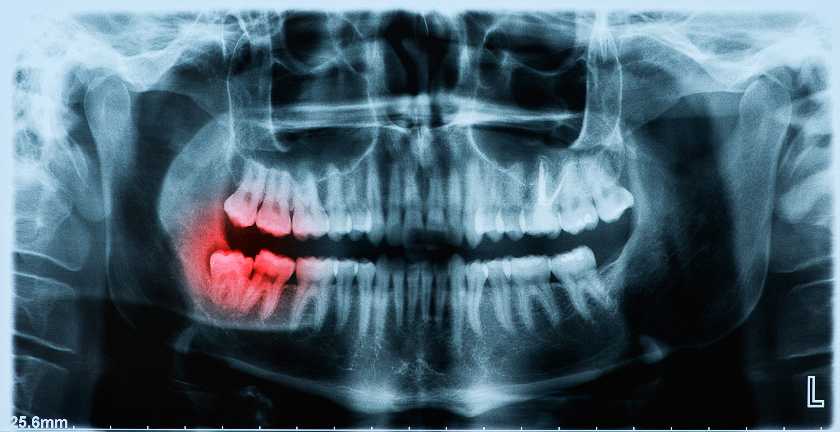 Oral Surgery: What Does Insurance Cover?