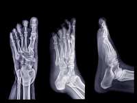 Don't Neglect Your Feet: Why You Should See a Podiatrist