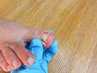 Ingrown Toenails: Why They Happen & How to Stop Them