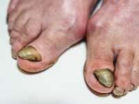 Why Your Toenails Change Color As You Age And When To See A Podiatrist