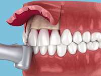 How Gum Health Affects the Longevity of Restorations and Cosmetic Work in The Woodlands, TX