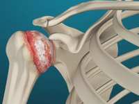 Understanding Total Shoulder Replacement: When is it the Right Choice?
