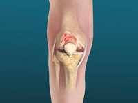 Understanding Total Knee Replacement: When is it the Right Choice?