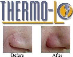 2025 Thermlo Treatments